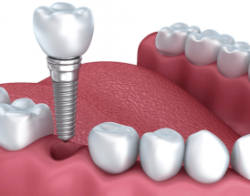 Cấy Ghép Implant Cho Người Mất Răng