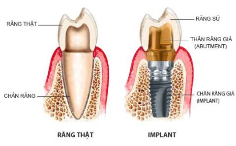 Trồng Răng Sứ Implant
